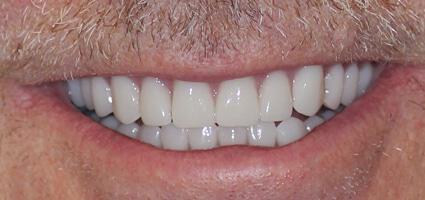Dentures after