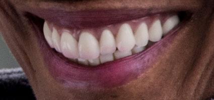Cosmetic Dentures after