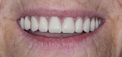 Dentures after