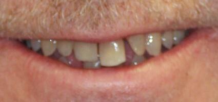 Dentures before