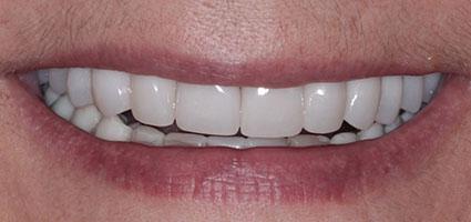 Porcelain Restorations and Neuromuscular Orthotic after