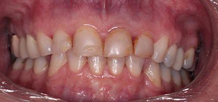 Porcelain Restorations and Neuromuscular Orthotic before