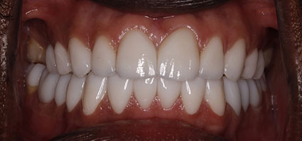 Smile Makeover/ Full Mouth Rehab after
