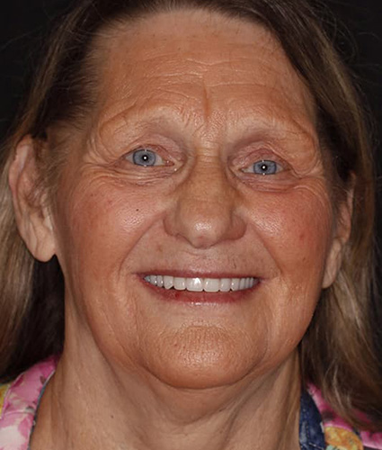 full face view of woman after dentures