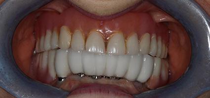 Cosmetic Dentures before
