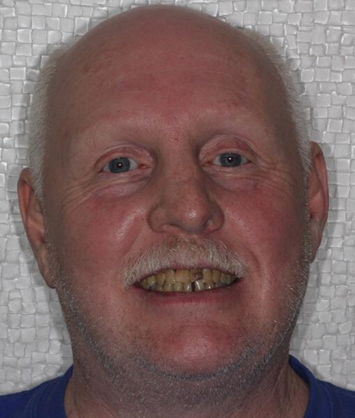 Implant Dentures before