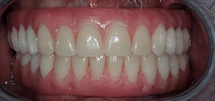 Implant Dentures after