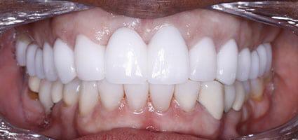 Dental Implant and Porcelain Veneers after