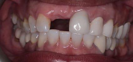 Dental Implant and Porcelain Veneers before
