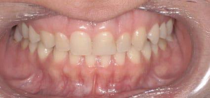 Teeth Brightening & Porcelain Veneers before