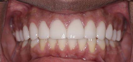 Porcelain Veneers and Invisalign after