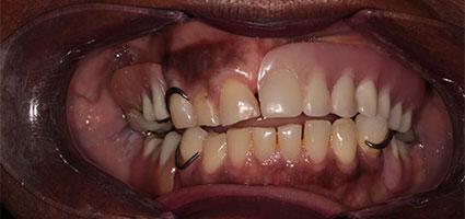 Dental Implants before