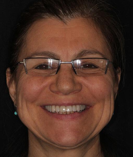 woman smiles after her new upper crowns