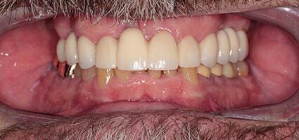 Dental Crowns and Bridge after