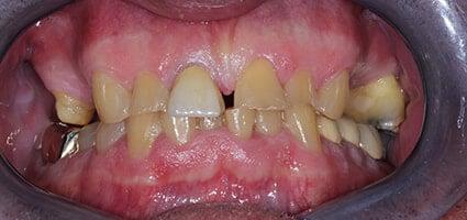 Dental Crowns and Bridge before