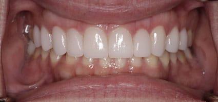 Teeth Brightening & Porcelain Veneers after