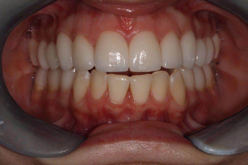 Full Mouth Reconstruction after