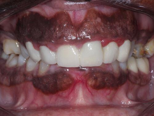 Full Mouth Reconstruction before