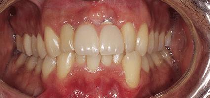 Implant Crowns after