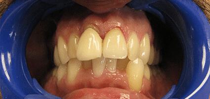 Implant Crowns before