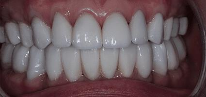 Full Mouth Restoration after