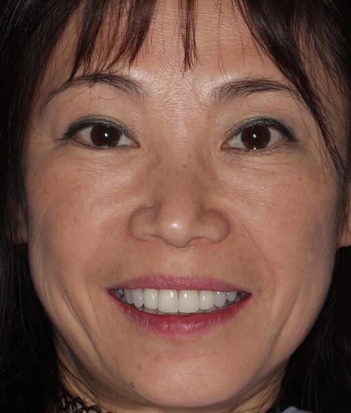 full face view of woman after dental veneers