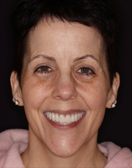 Smile Makeover (Full Mouth Recon.)
