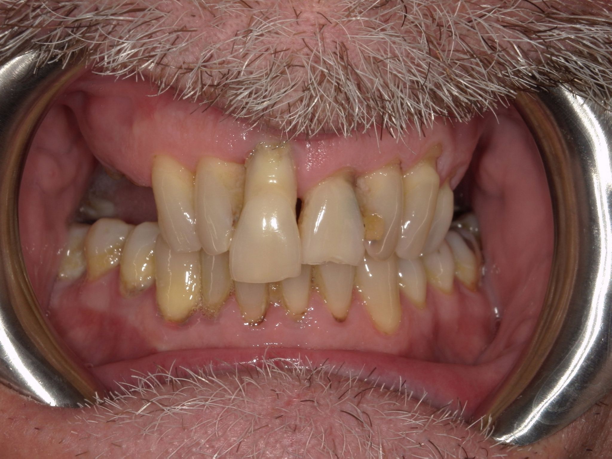 Implant Dentistry