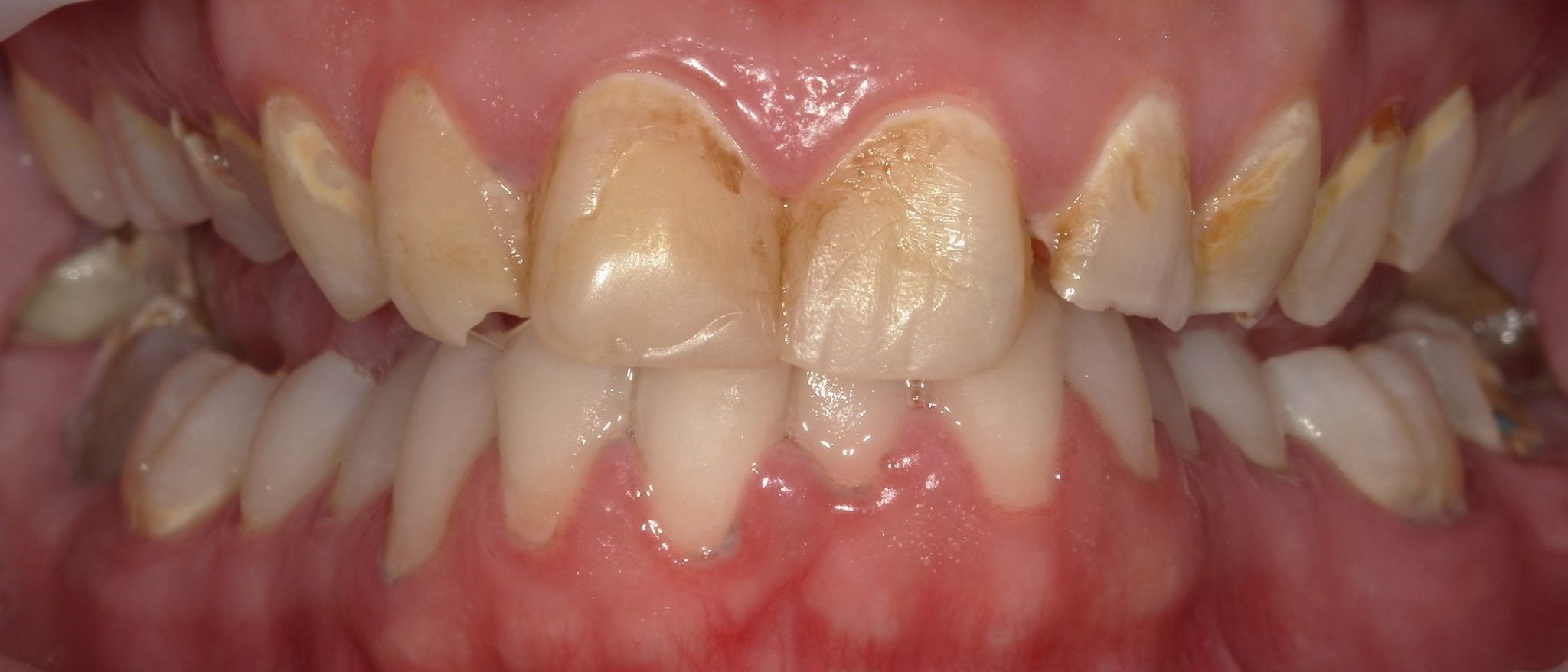 Smile Makeover (Full Mouth Recon.)