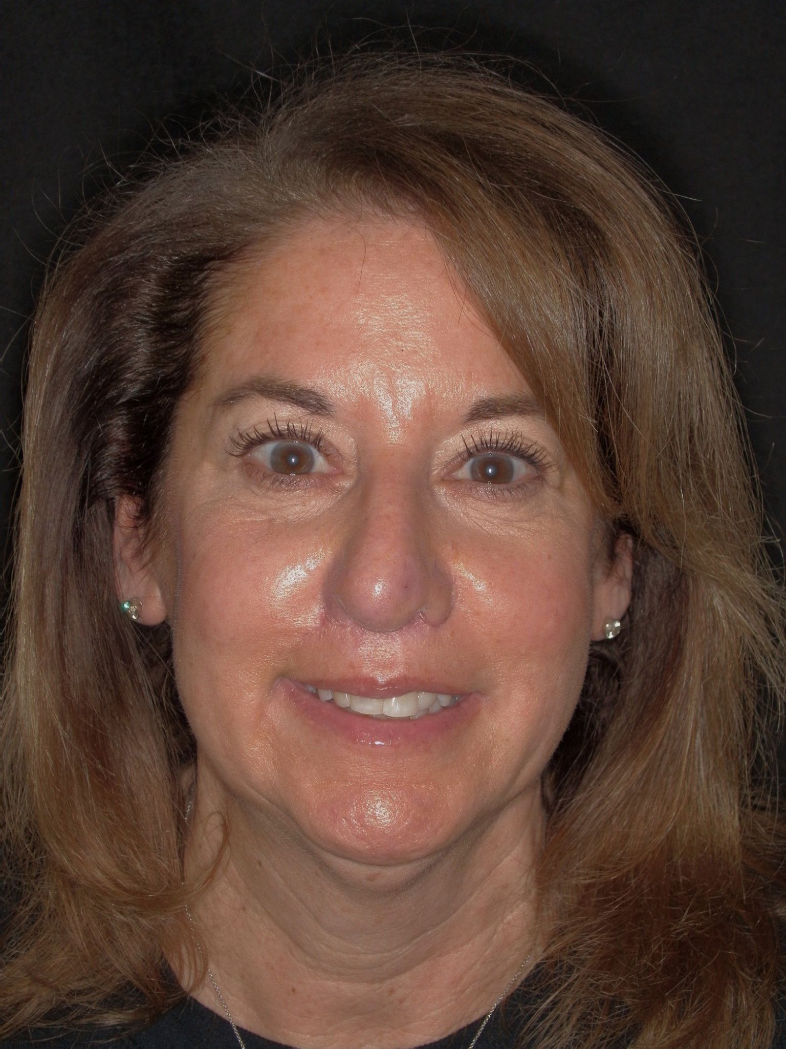 Smile Makeover (Full Mouth Recon.)