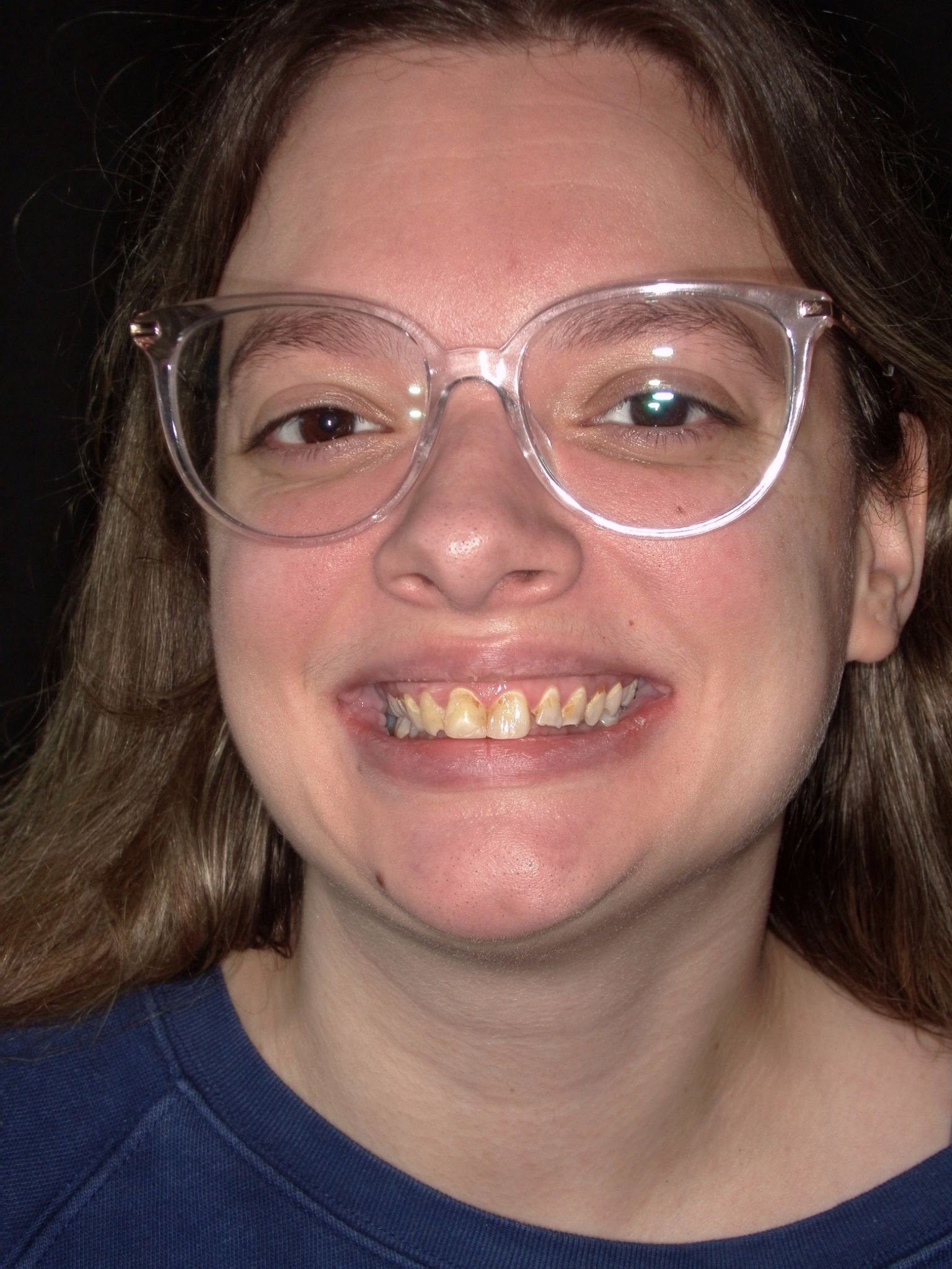 Smile Makeover (Full Mouth Recon.)