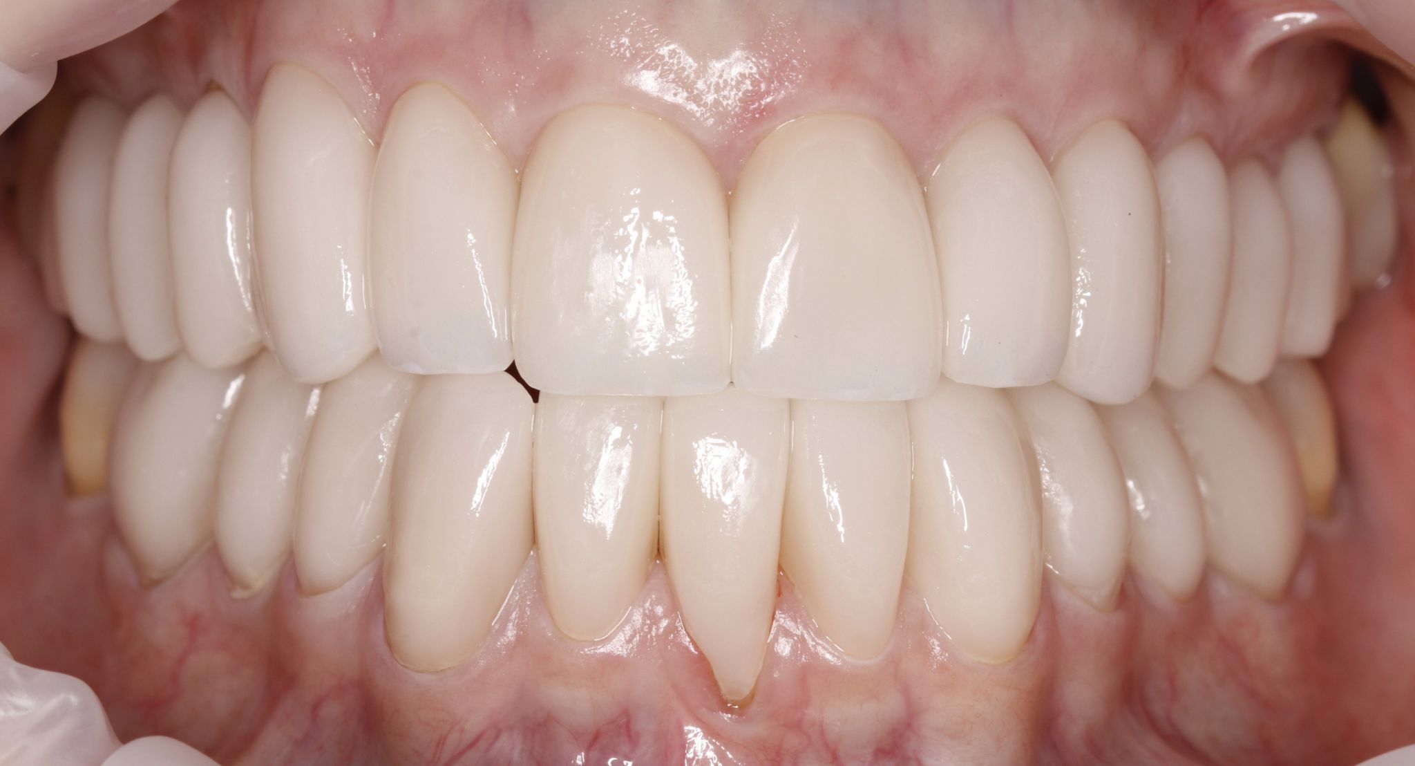 Smile Makeover (Full Mouth Recon.)