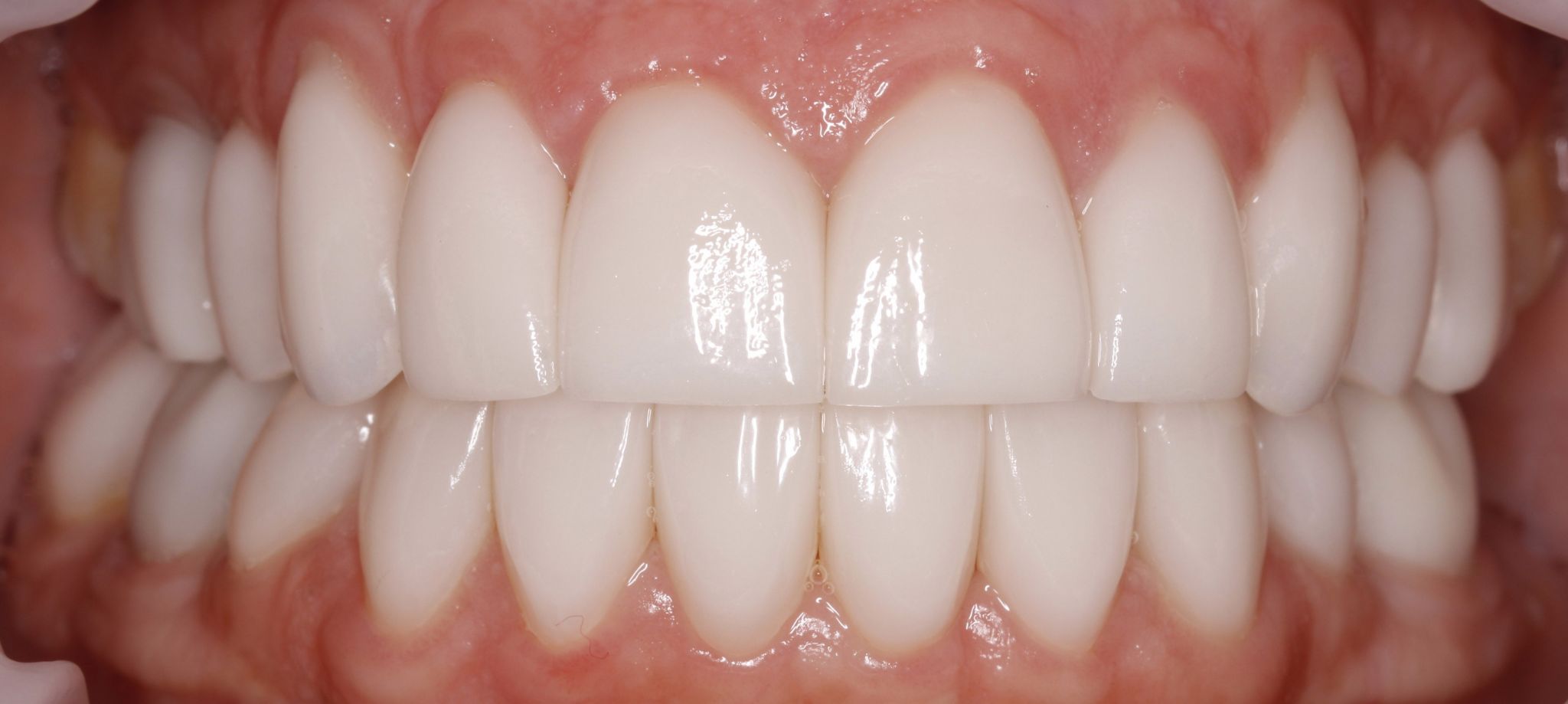 Smile Makeover (Full Mouth Recon.)