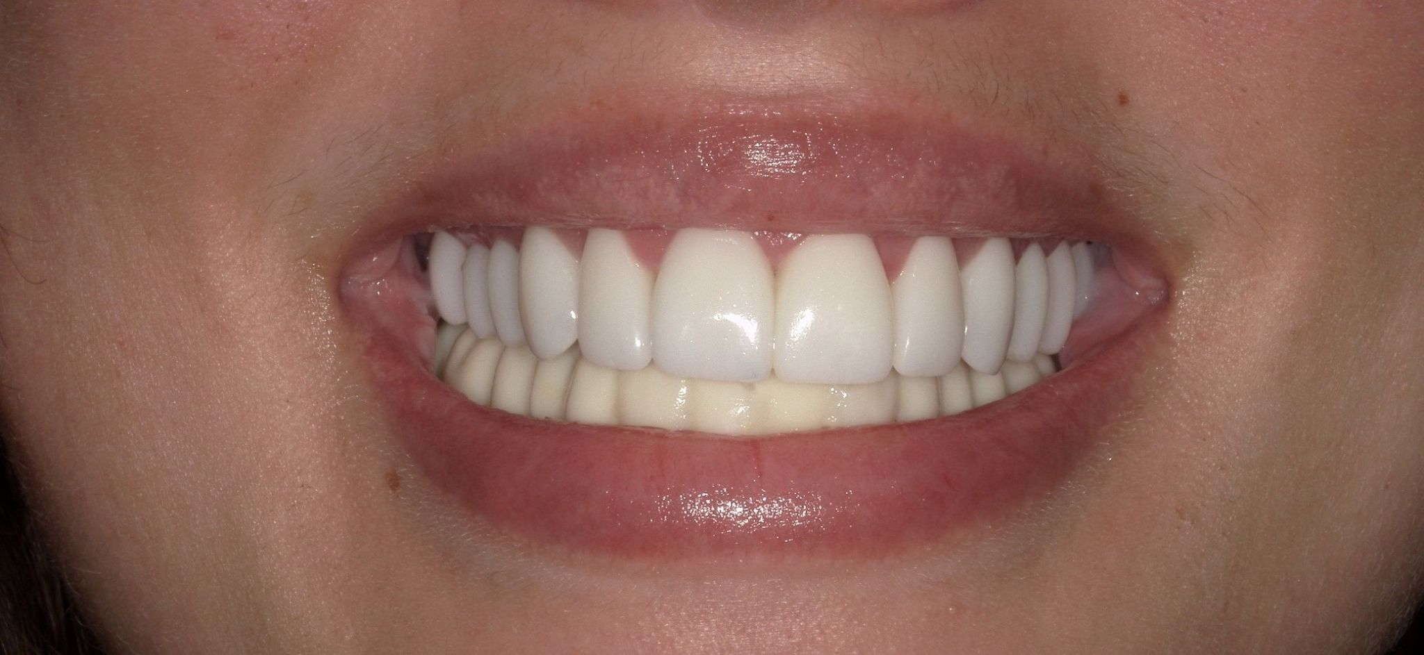 Smile Makeover (Full Mouth Recon.)