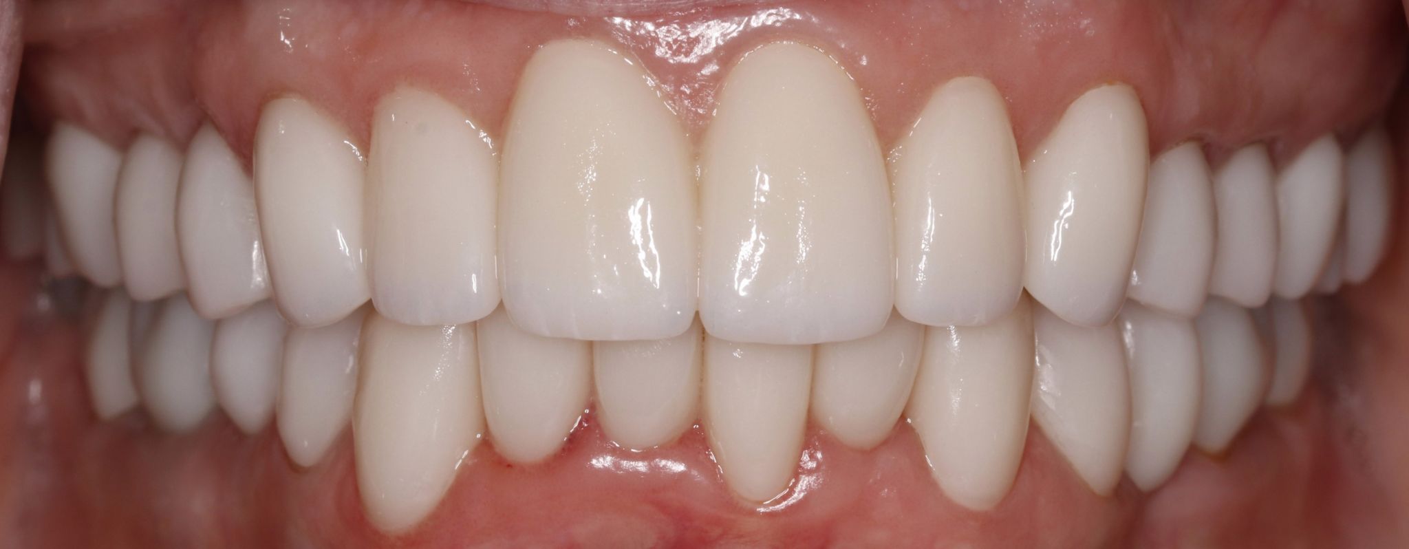 Smile Makeover (Full Mouth Recon.)