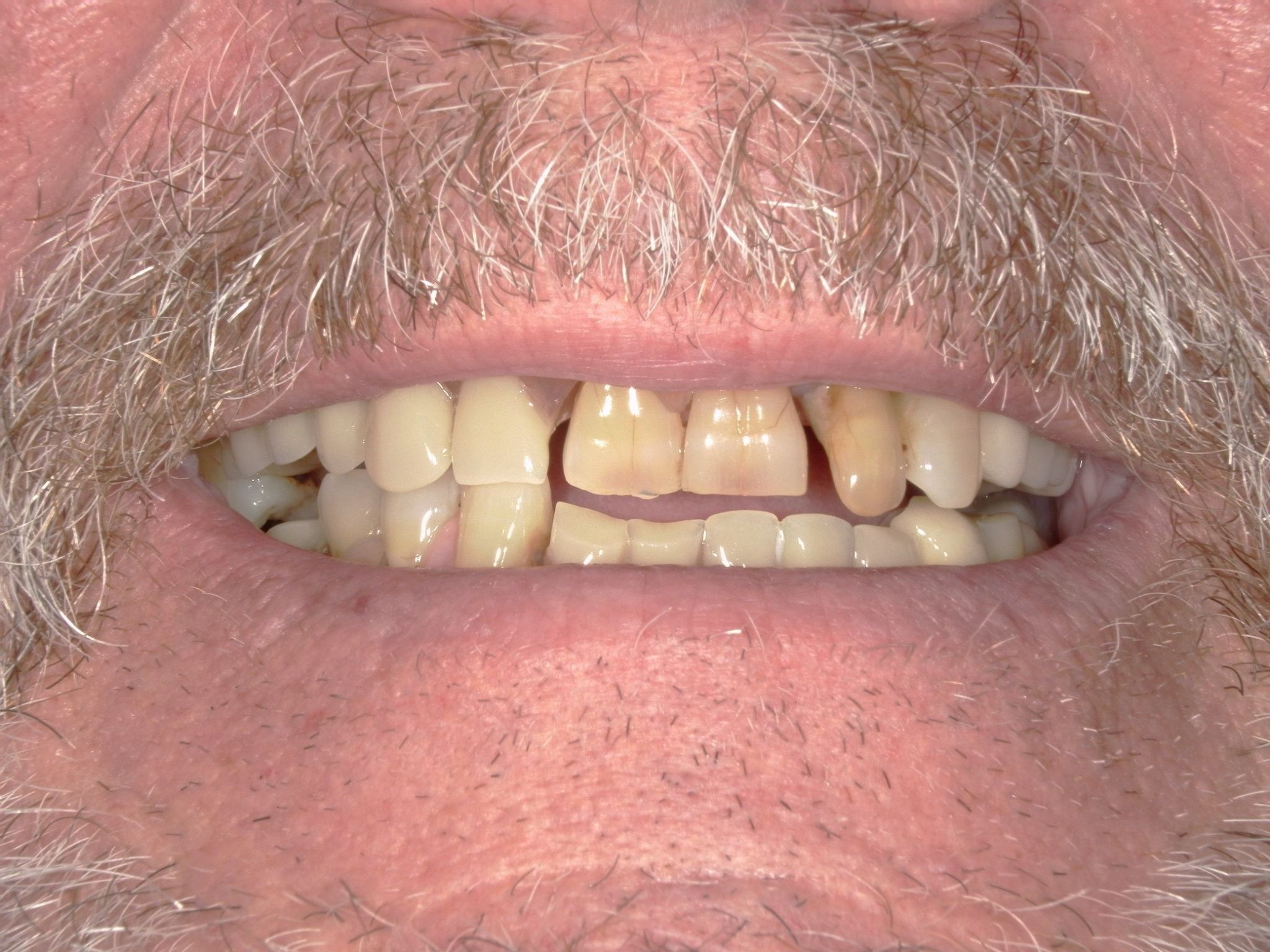Implant Dentistry