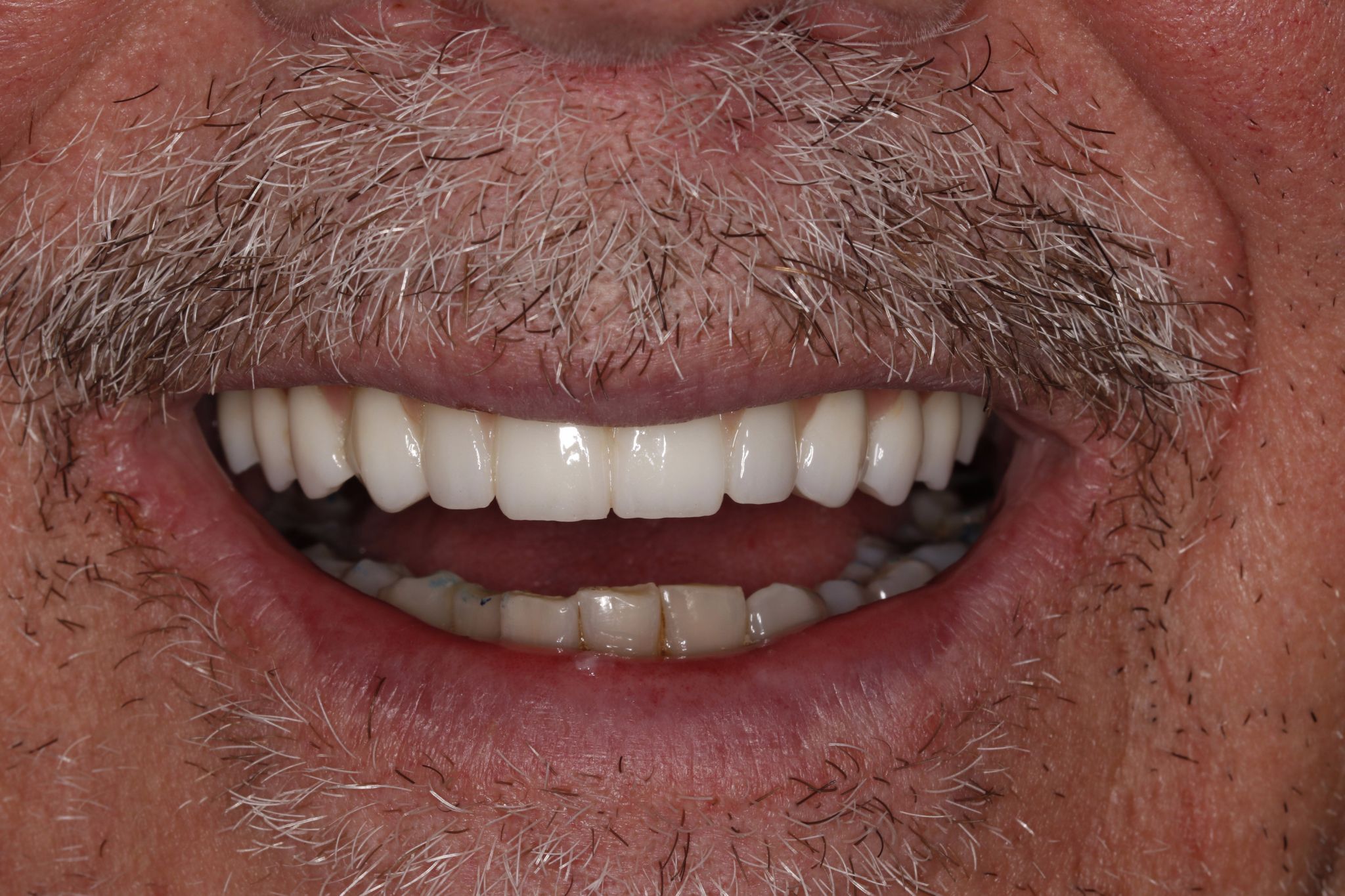 Implant Dentistry