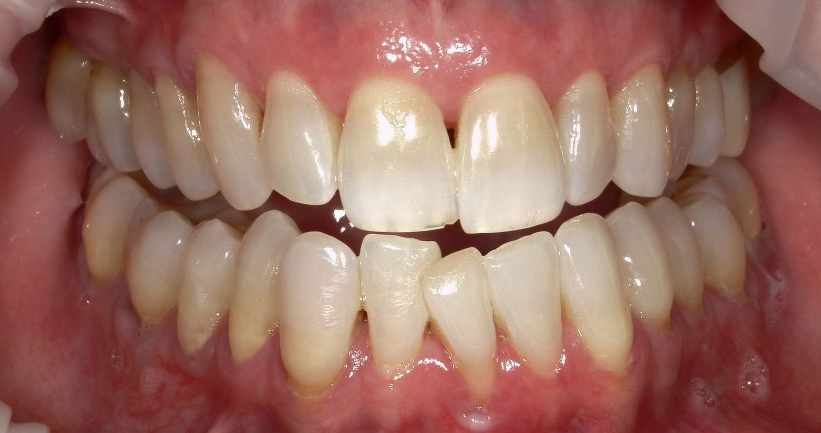 Smile Makeover (Full Mouth Recon.)