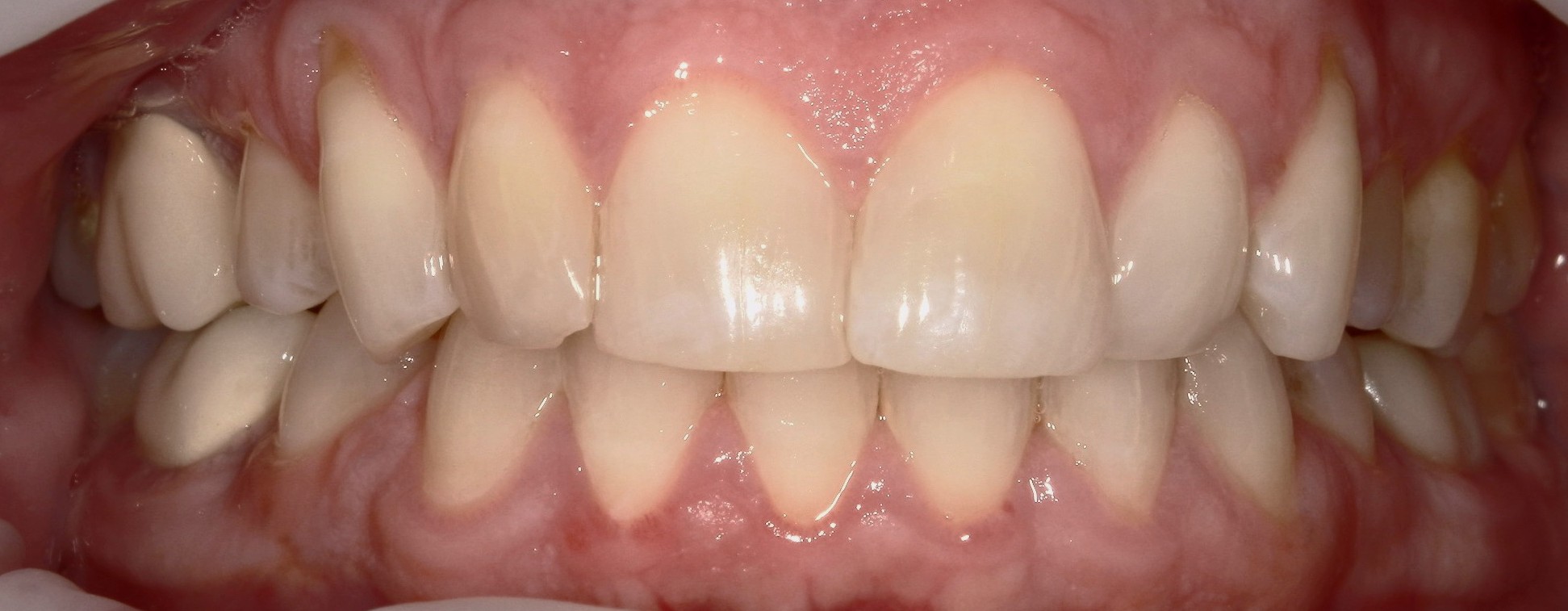 Smile Makeover (Full Mouth Recon.)