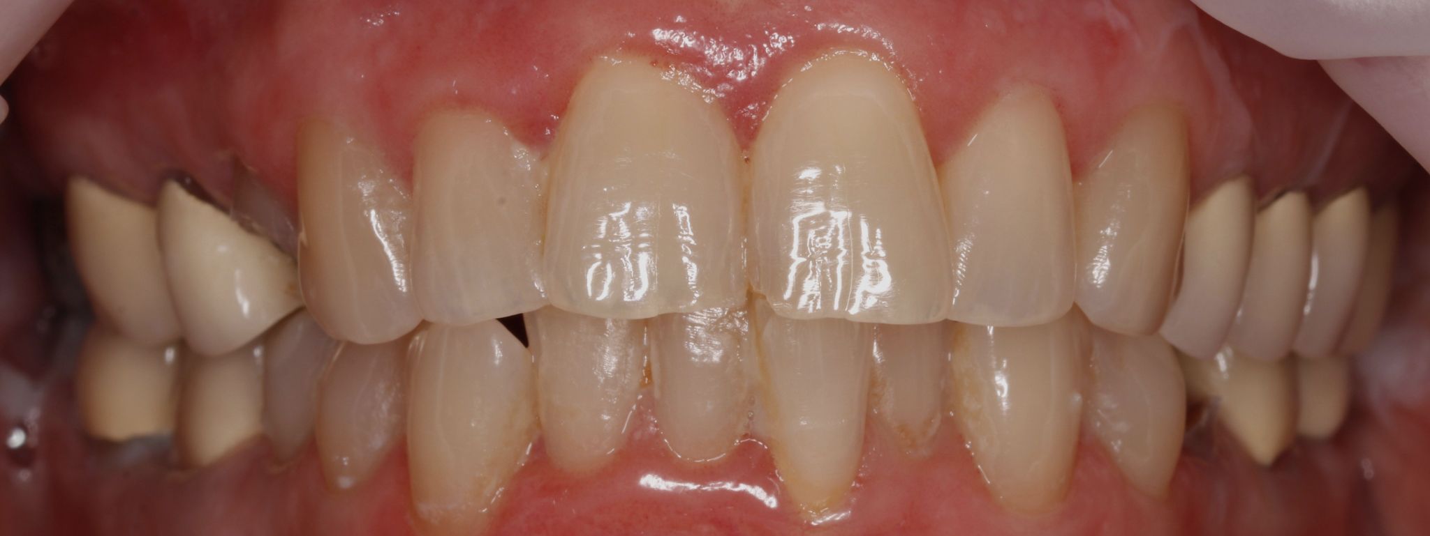 Smile Makeover (Full Mouth Recon.)