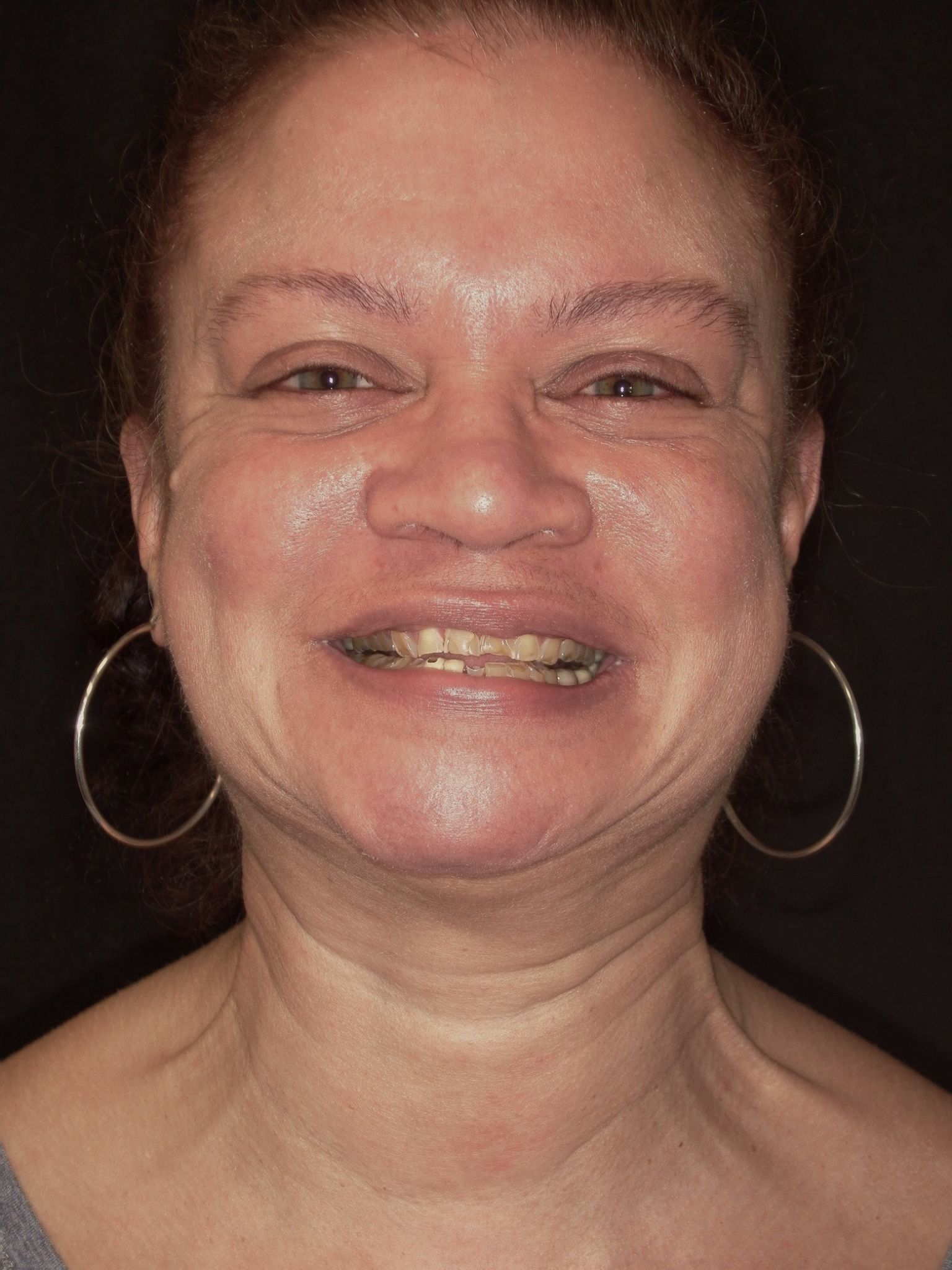Smile Makeover (Full Mouth)