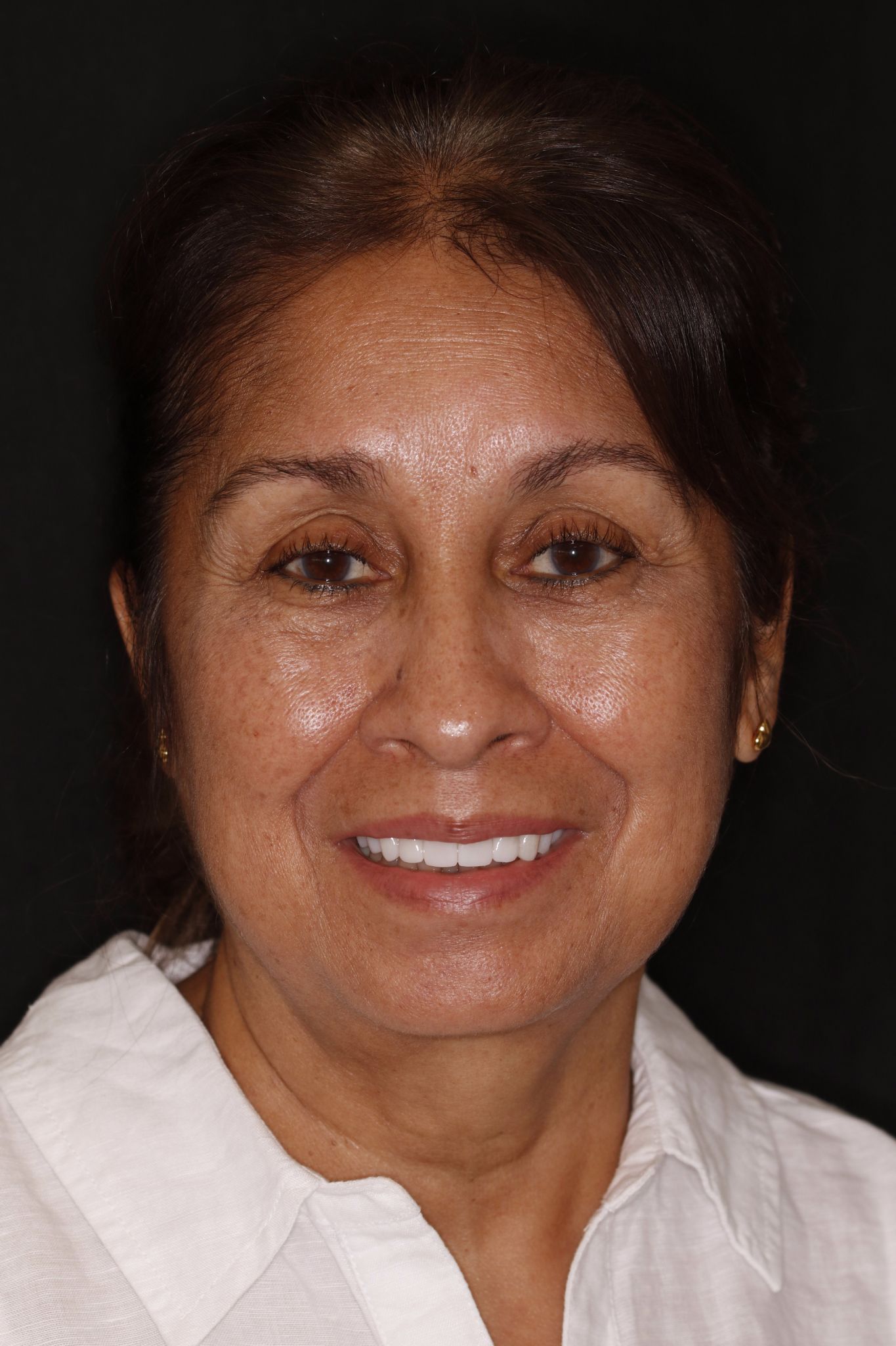 Cosmetic Dentures