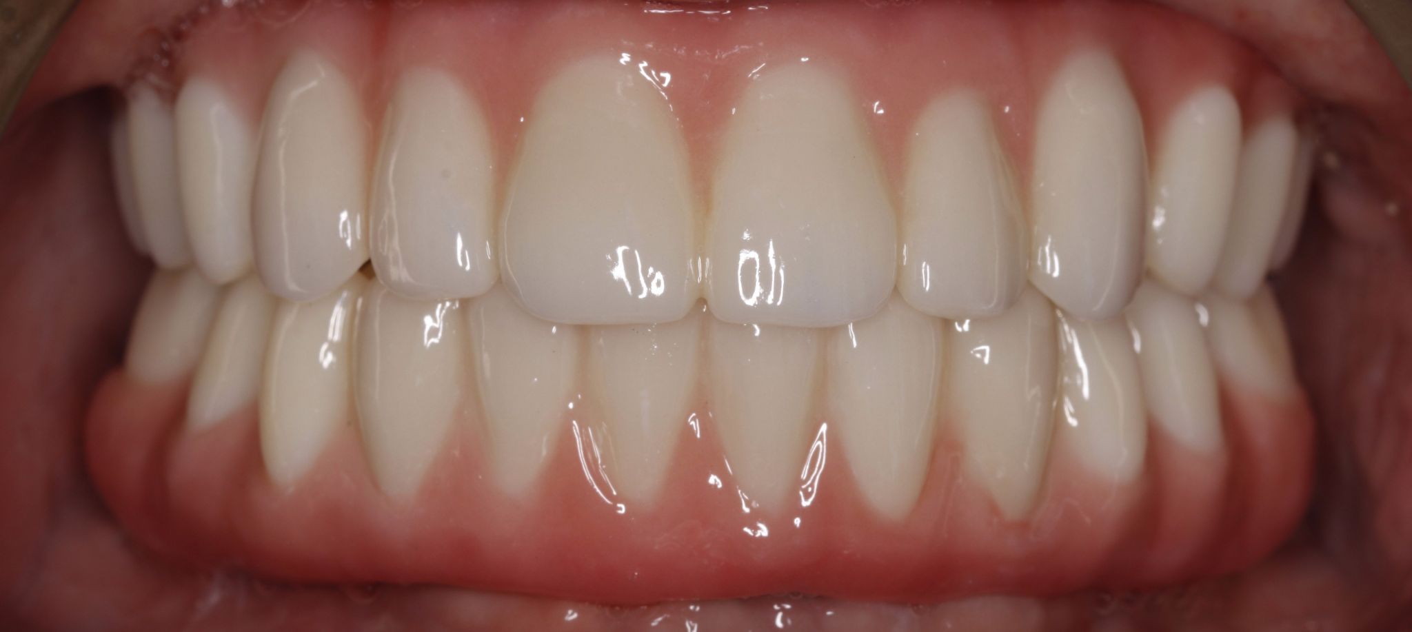 Implant Dentistry