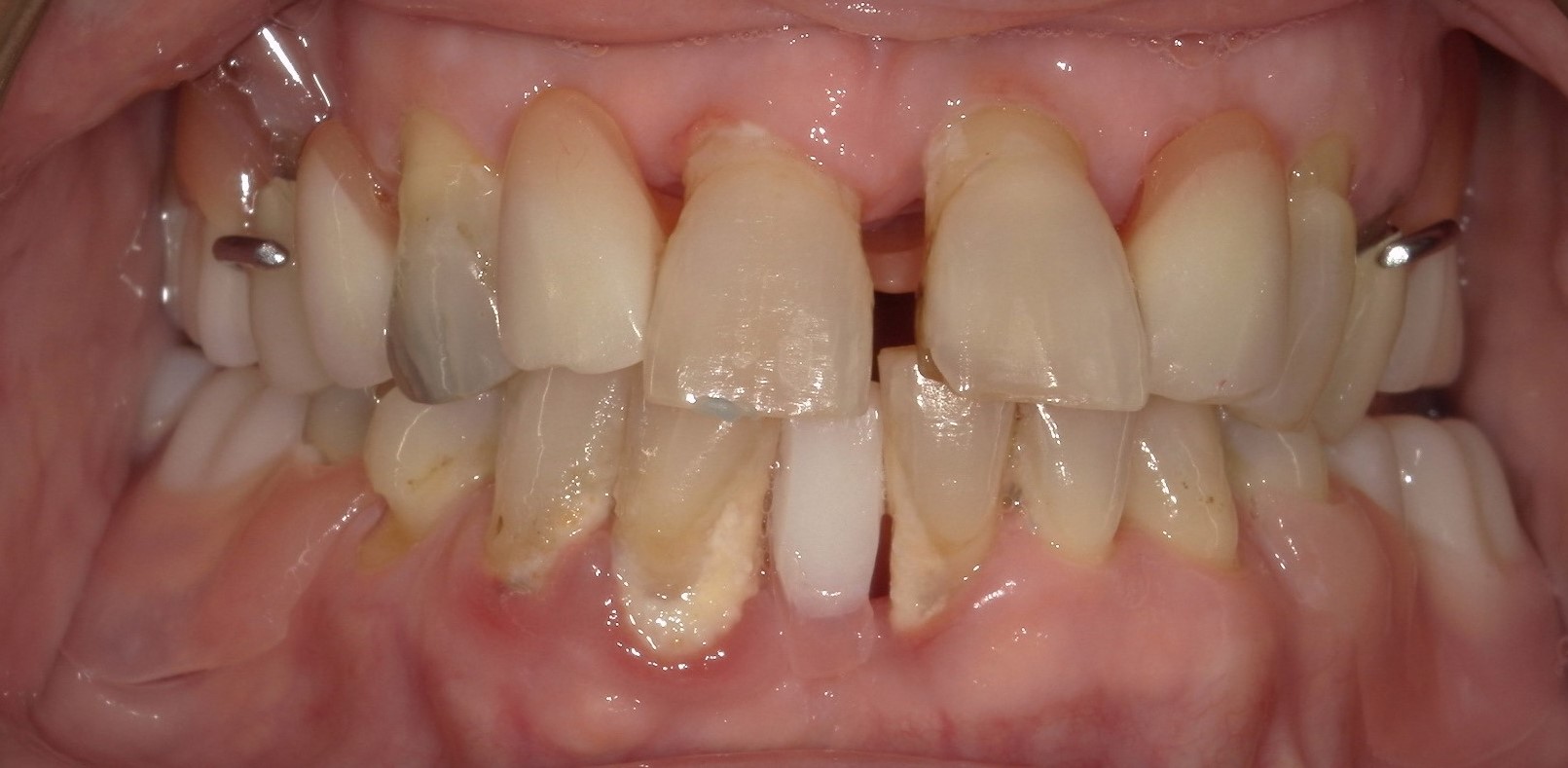 Implant Dentistry