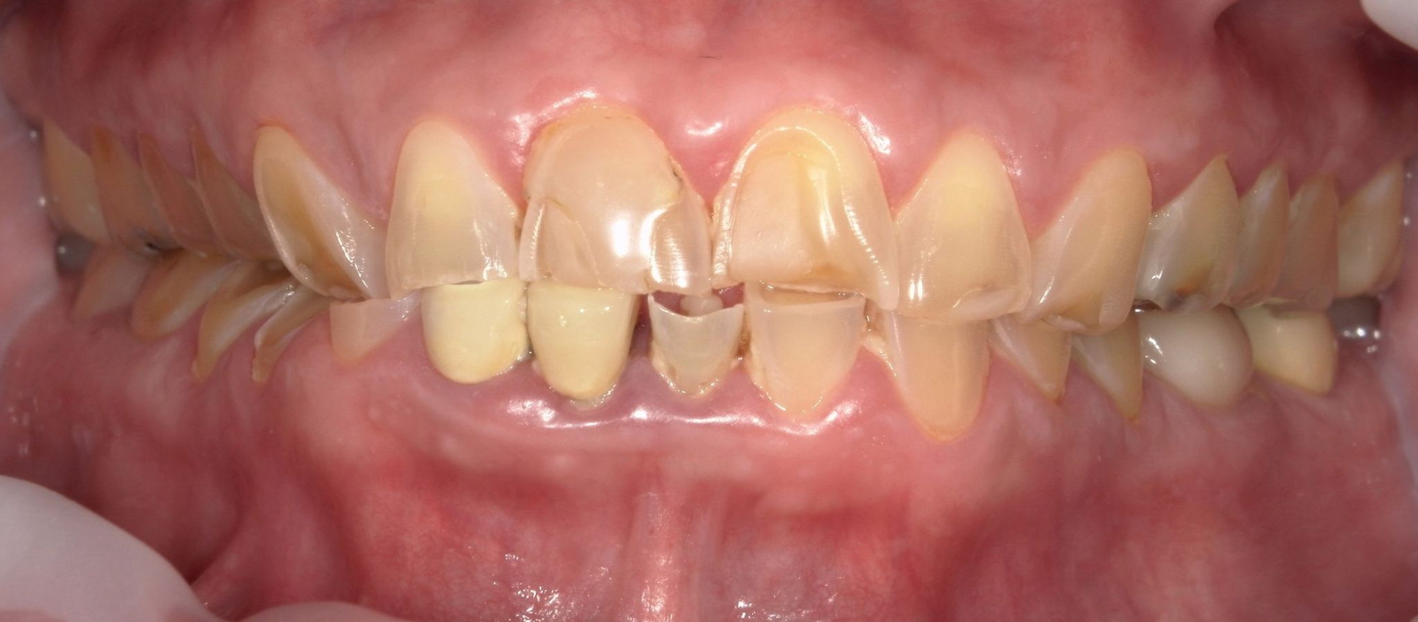 Smile Makeover (Full Mouth)