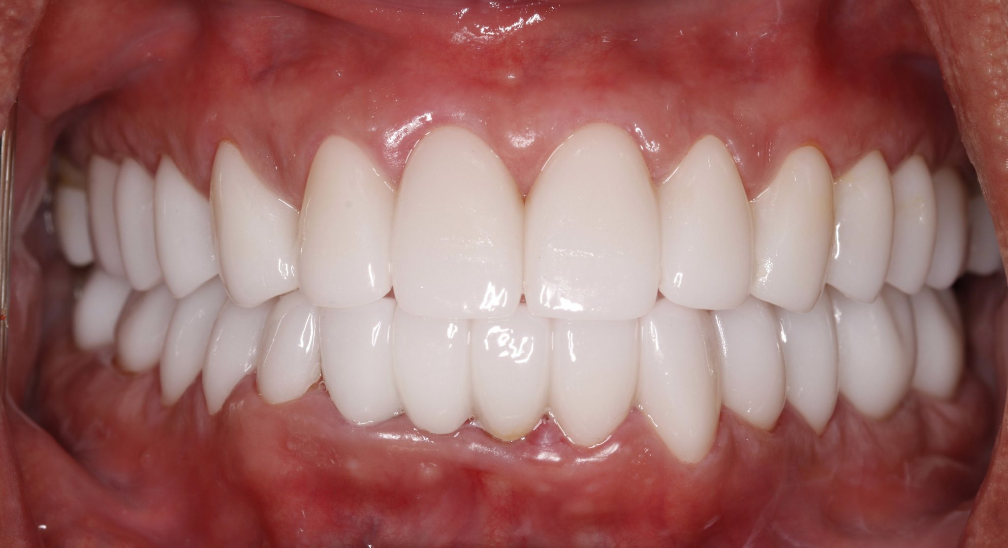 Smile Makeover (Full Mouth)
