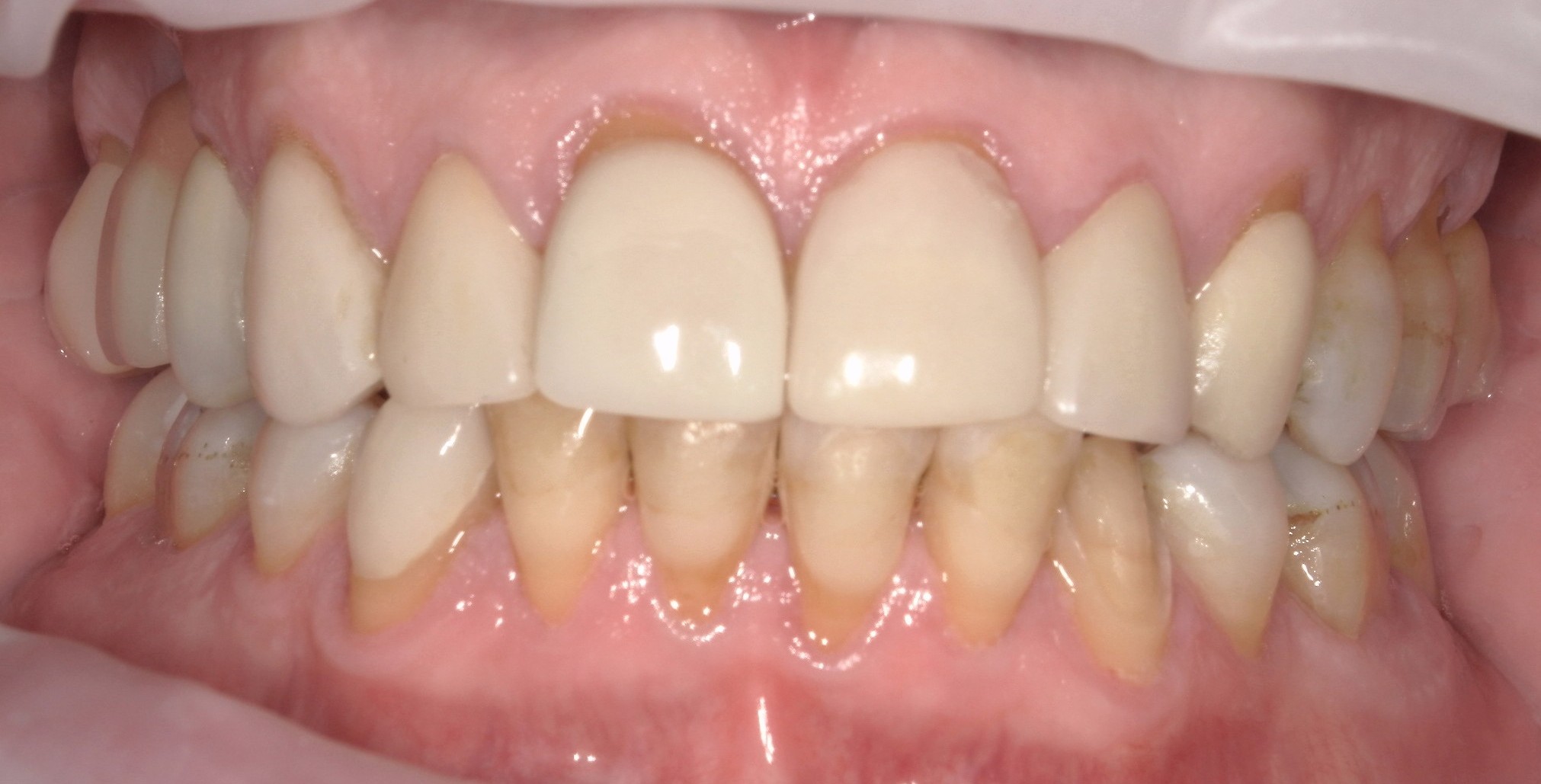 Smile Makeover (Full Mouth)