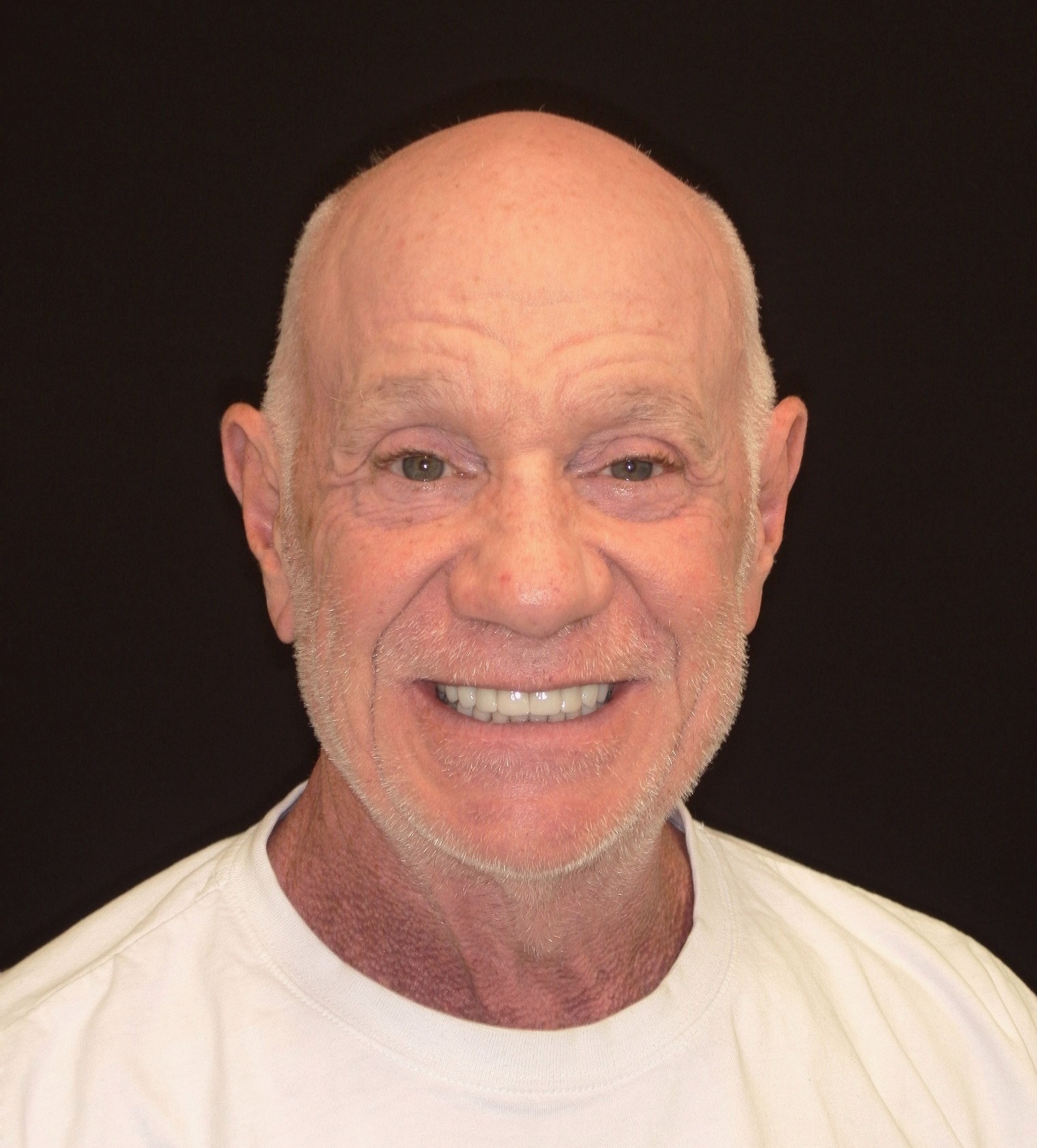 Smile Makeover (Full Mouth)