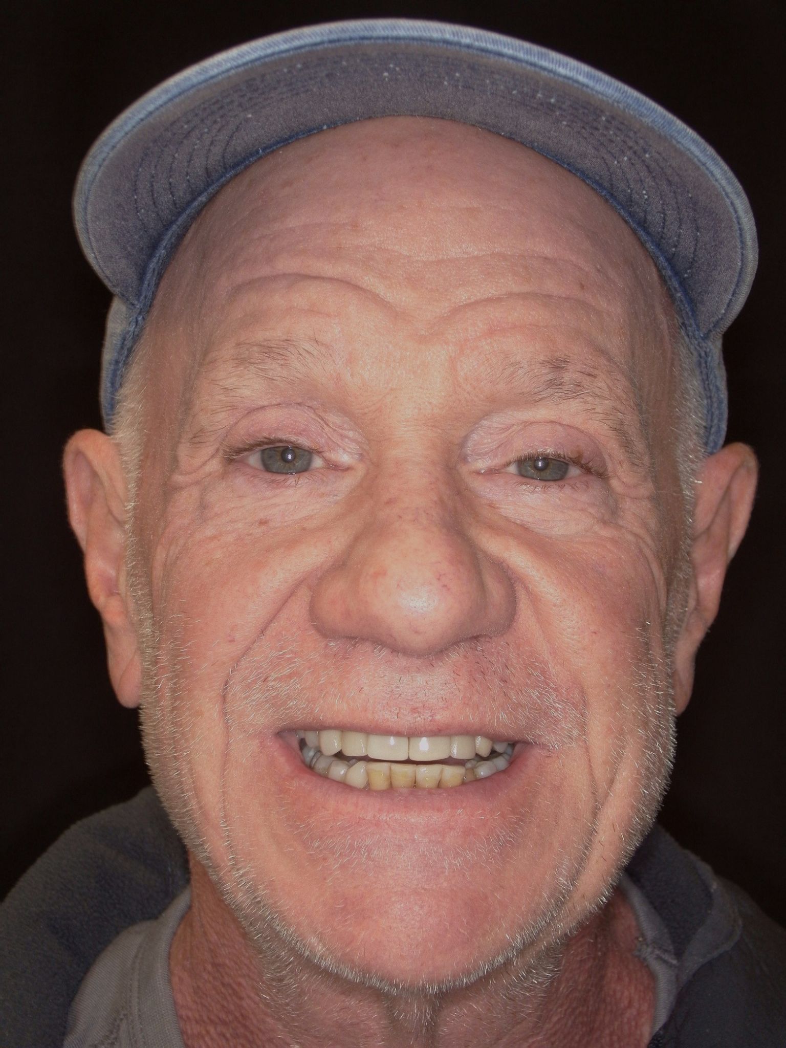 Smile Makeover (Full Mouth)