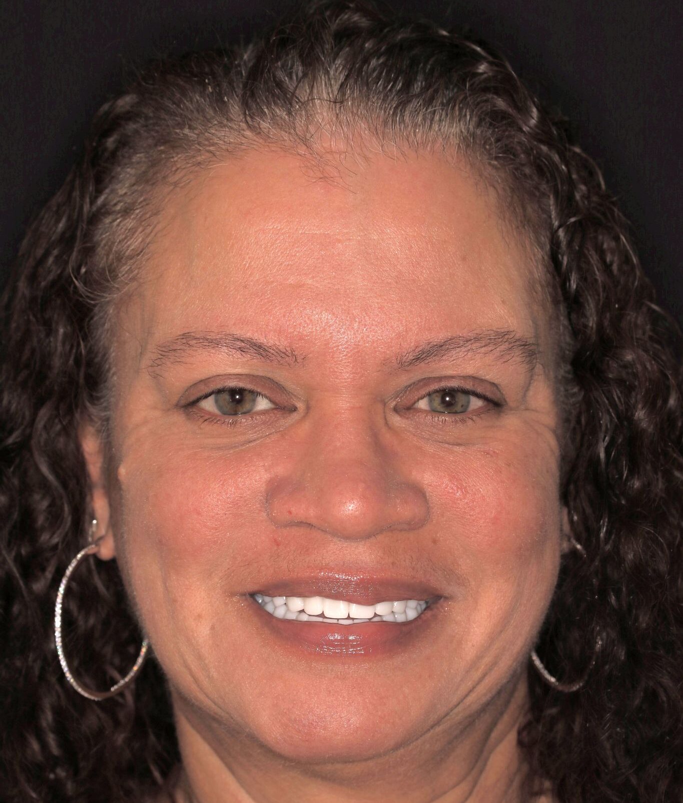 Smile Makeover (Full Mouth)